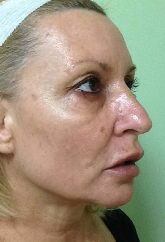 Before Image: Fractional Non-Ablative Laser Resurfacing - right-front-oblique