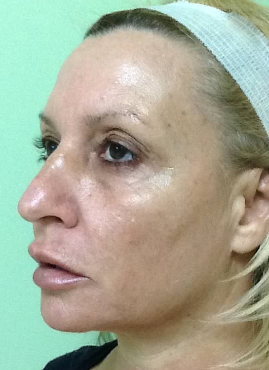 Before Image: Fractional Non-Ablative Laser Resurfacing - left-side
