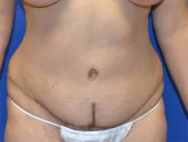 After Image: Tummy Tuck with Liposuction - front