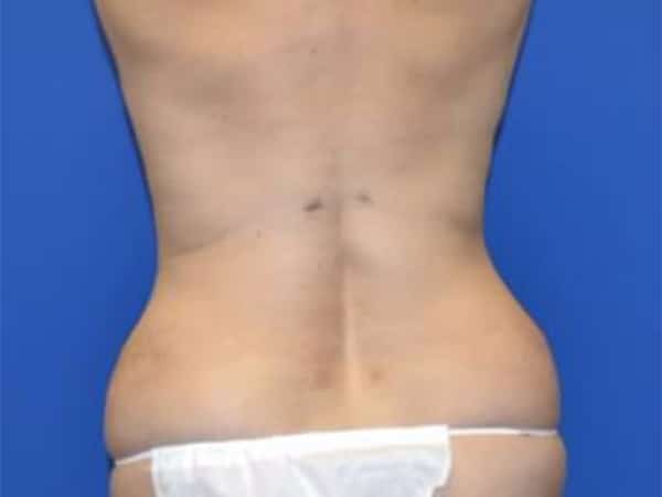 After Image: Tummy Tuck with Liposuction - back