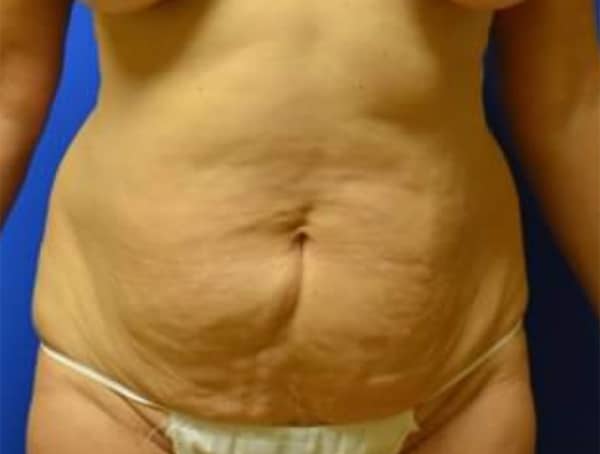 Before Image: Tummy Tuck with Liposuction - front
