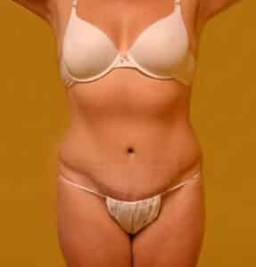 After Image: Tummy Tuck with Liposuction