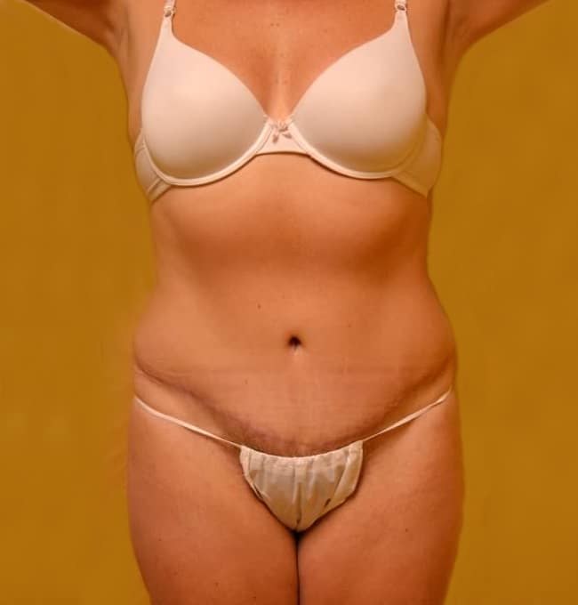 After Image: Tummy Tuck with Liposuction - front