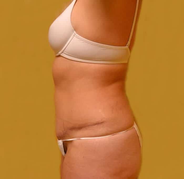 After Image: Tummy Tuck with Liposuction - left-side