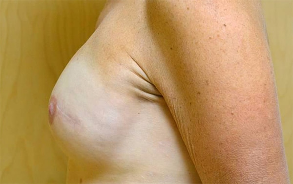 After Image: Breast Reconstruction - left-side
