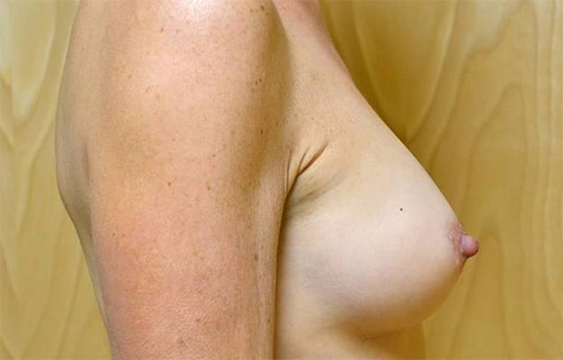 After Image: Breast Reconstruction - right-side