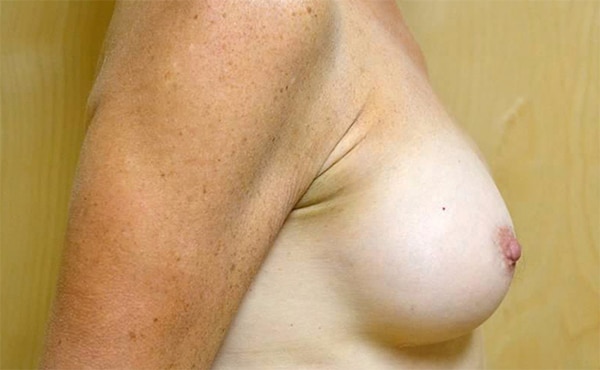 After Image: Breast Reconstruction - right-side