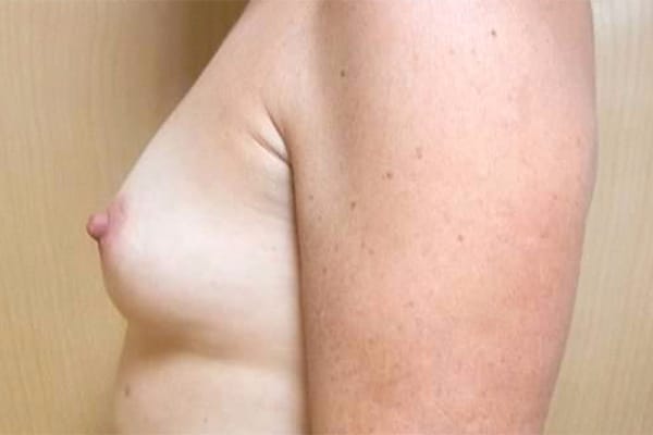 Before Image: Breast Reconstruction - left-side