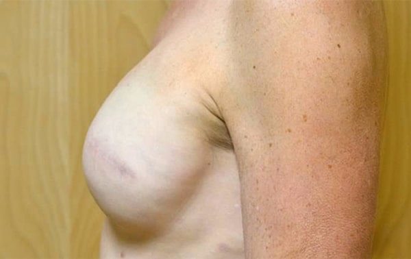 Before Image: Breast Reconstruction - left-side
