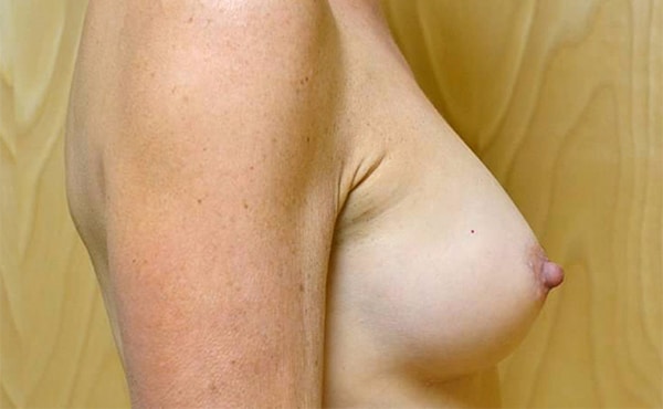 Before Image: Breast Reconstruction - right-side