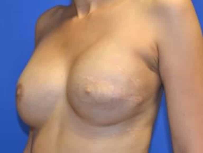 After Image: Breast Reconstruction - left-front-oblique