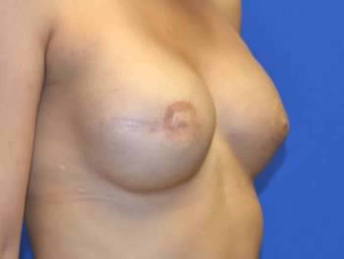 After Image: Breast Reconstruction - right-front-oblique
