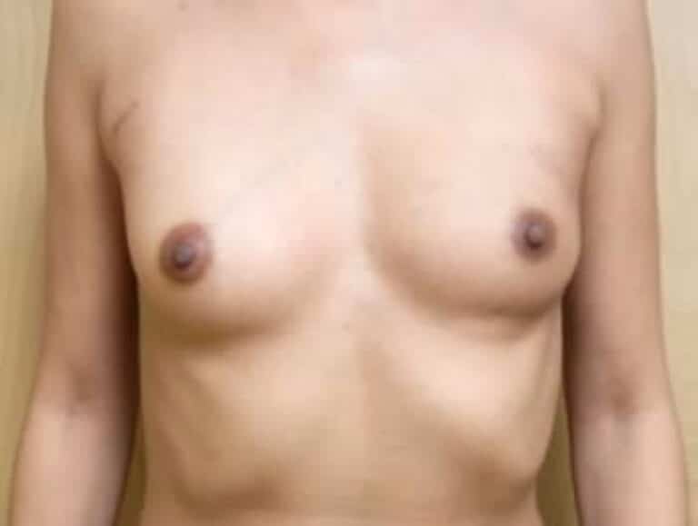 Before Image: Breast Reconstruction - front