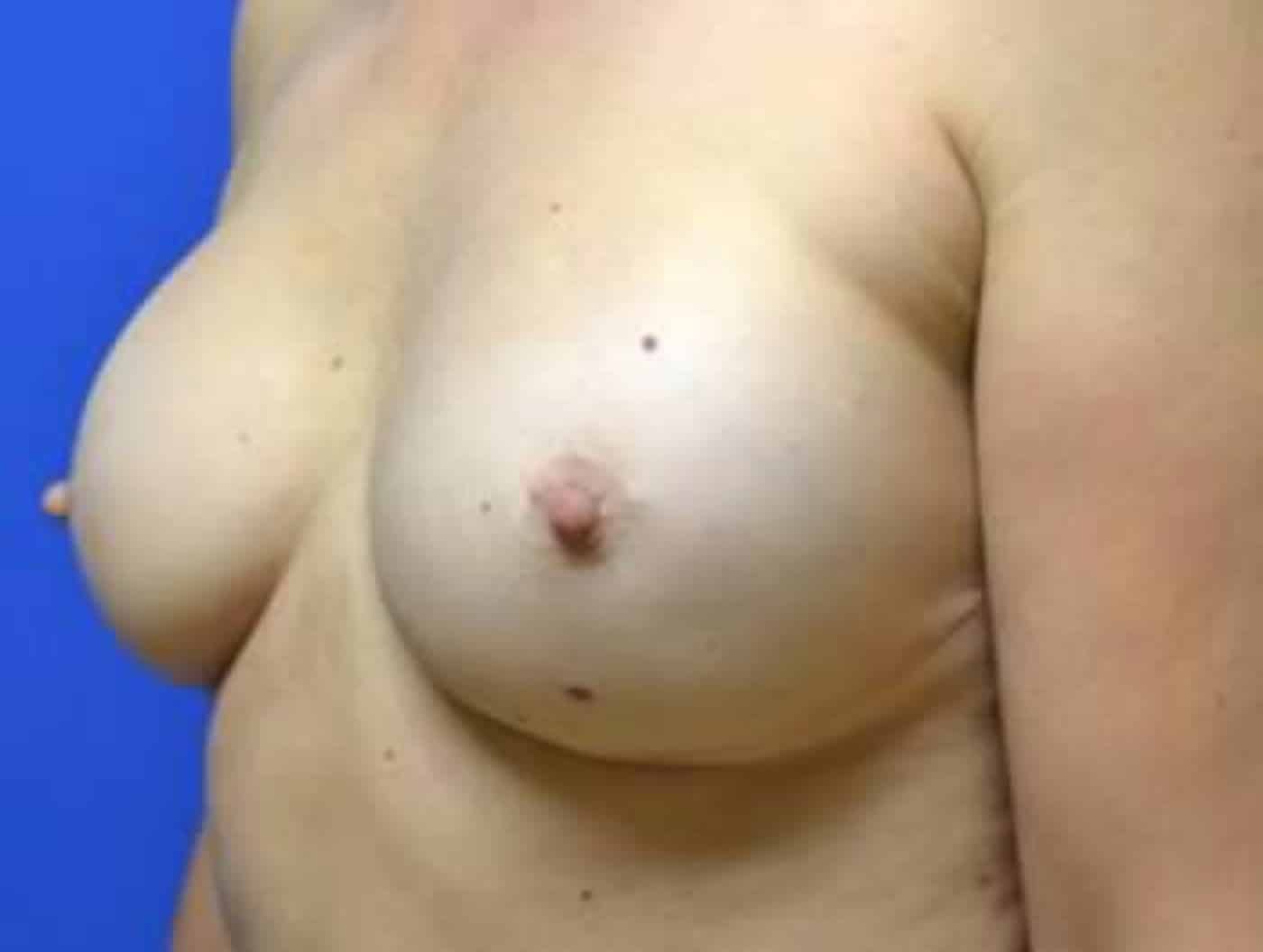 After Image: Breast Reconstruction - left-front-oblique