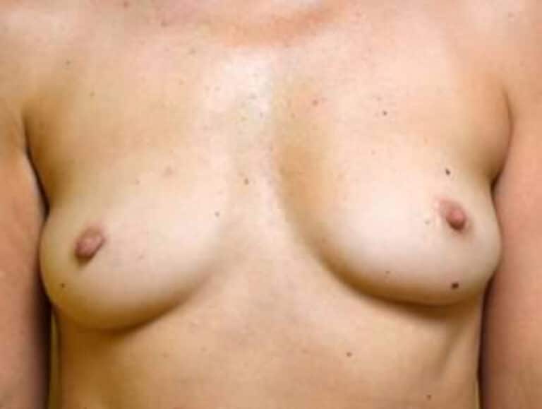 Before Image: Breast Reconstruction - front