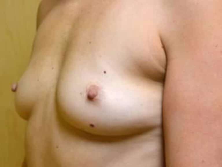 Before Image: Breast Reconstruction - left-front-oblique