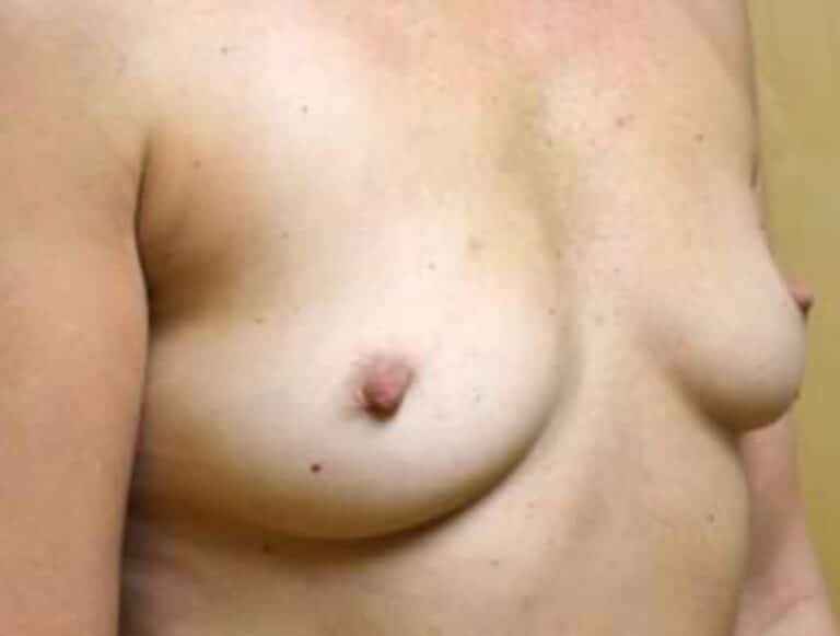 Before Image: Breast Reconstruction - right-front-oblique