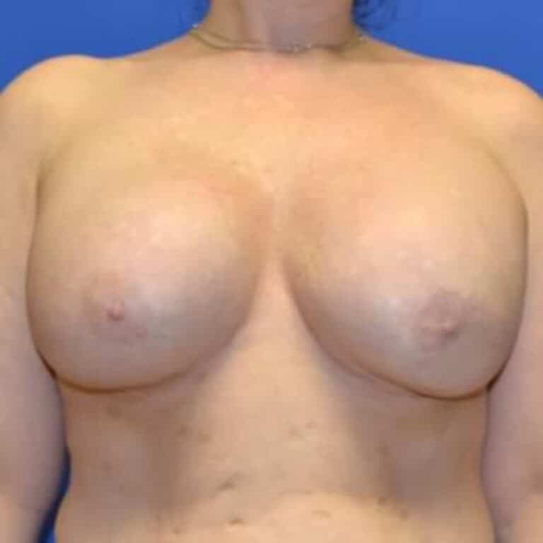 After Image: Breast Reconstruction - front