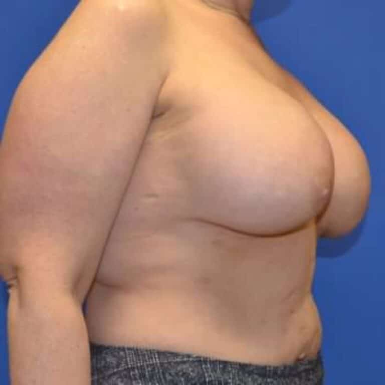 After Image: Breast Reconstruction - right-front-oblique