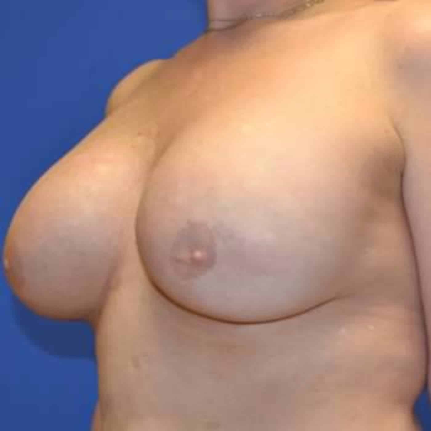 After Image: Breast Reconstruction - left-front-oblique