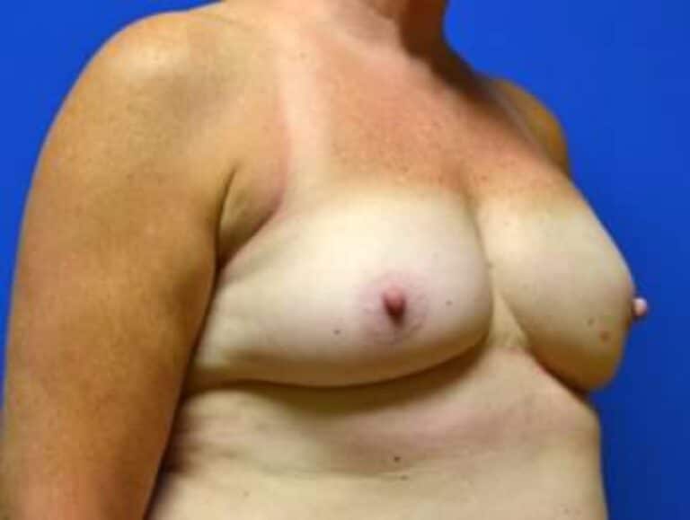 After Image: Breast Reconstruction - right-front-oblique