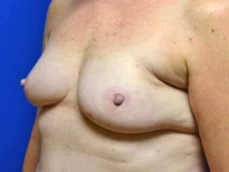 After Image: Breast Reconstruction - left-front-oblique