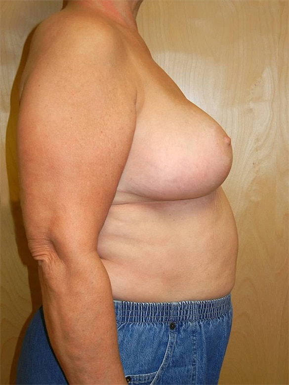After Image: Breast Reduction - right-side