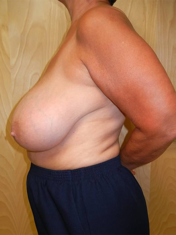 Before Image: Breast Reduction - left-side