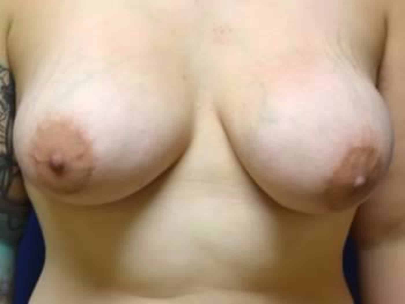 After Image: Breast Augmentation - front