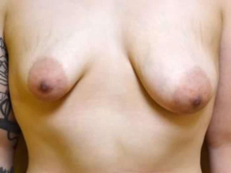 Before Image: Breast Augmentation - front