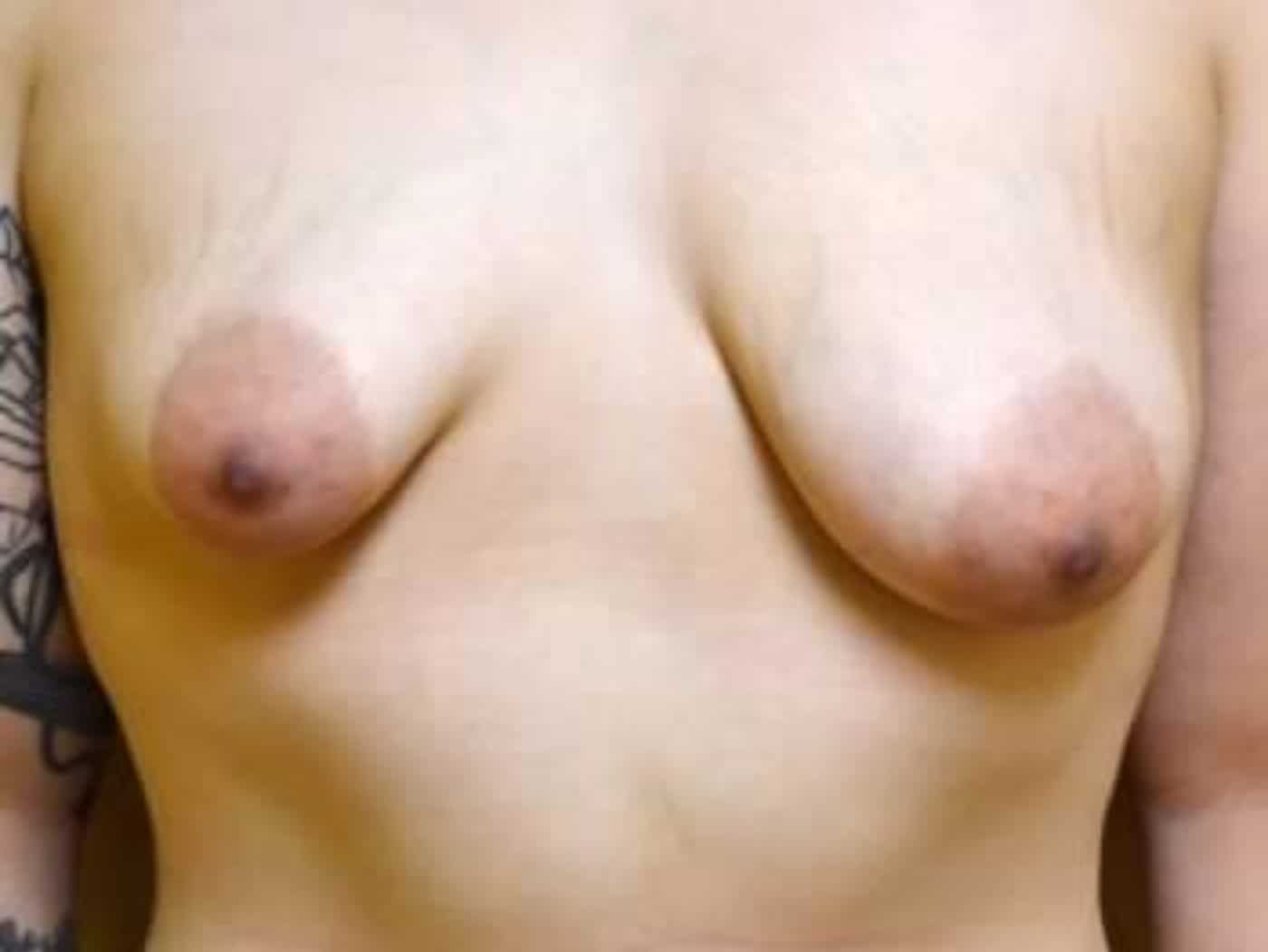 Before Image: Breast Augmentation - front