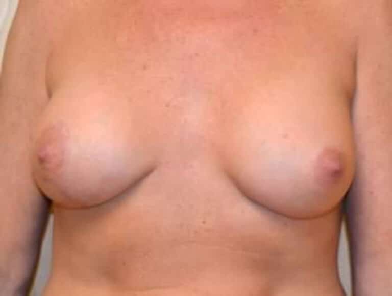 After Image: Breast Augmentation - front