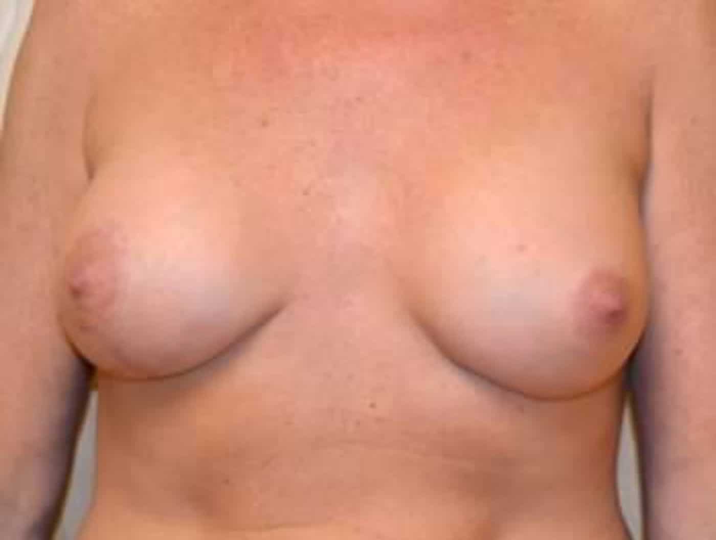 After Image: Breast Augmentation - front