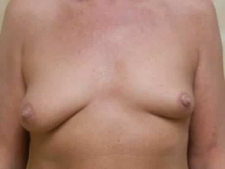 Before Image: Breast Augmentation - front