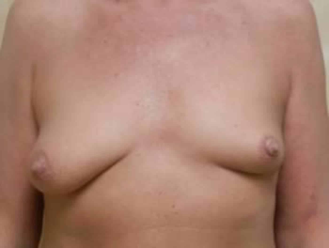 Before Image: Breast Augmentation - front