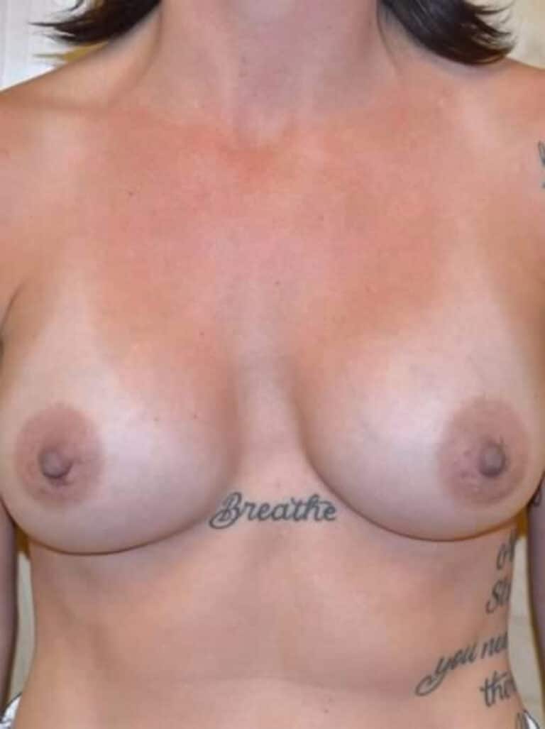 After Image: Breast Augmentation - front