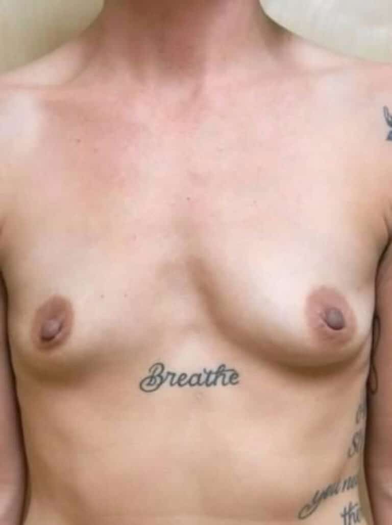 Before Image: Breast Augmentation - front