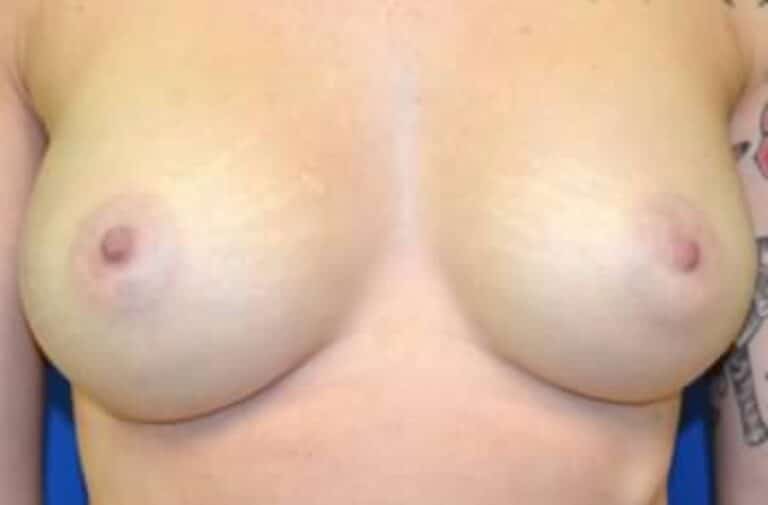 After Image: Breast Augmentation - front