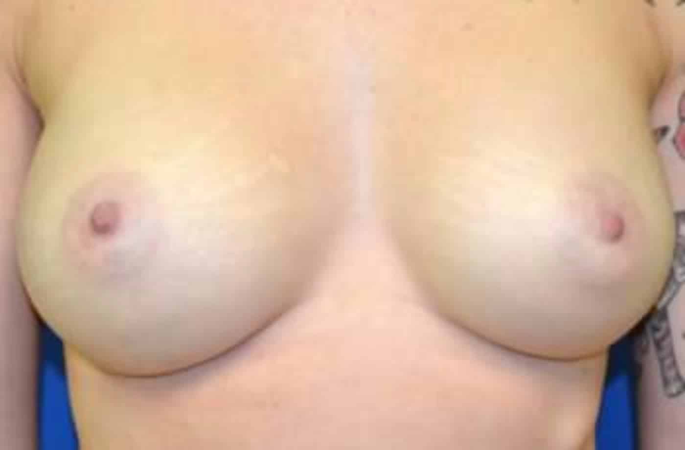After Image: Breast Augmentation - front