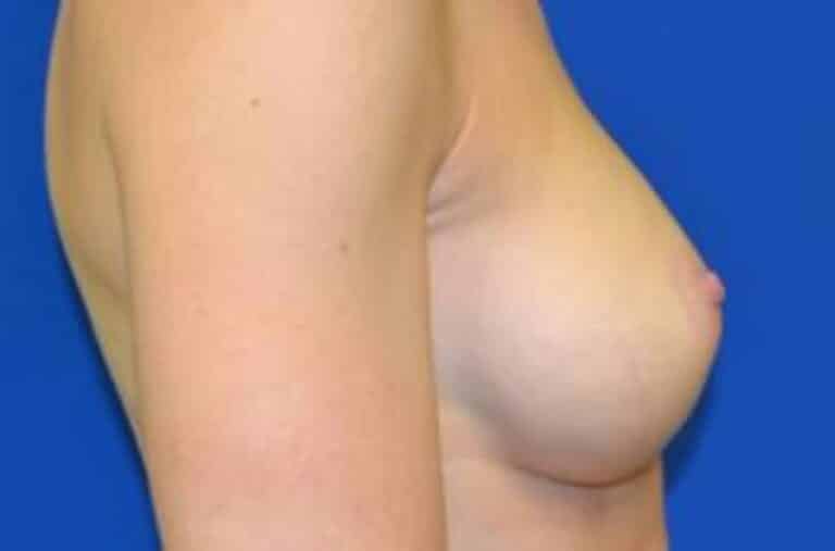 After Image: Breast Augmentation - right-side