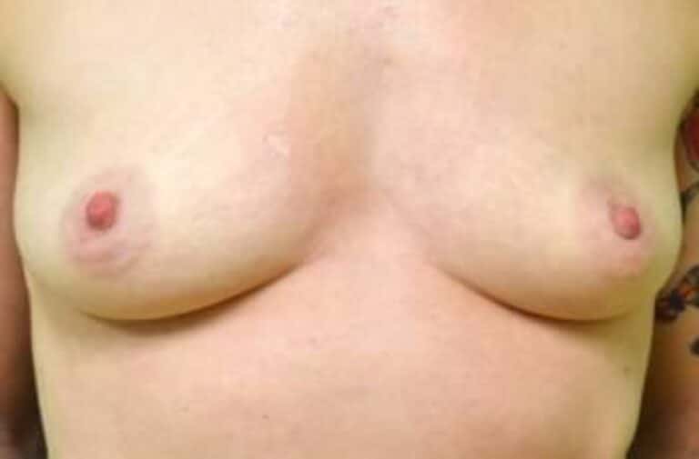 Before Image: Breast Augmentation - front