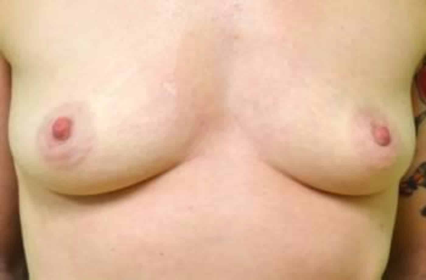 Before Image: Breast Augmentation - front