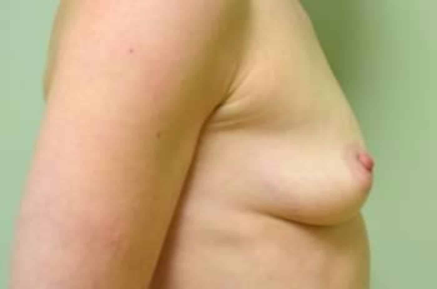 Before Image: Breast Augmentation - right-side