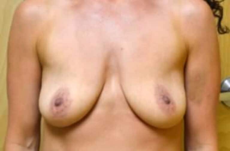 Before Image: Breast Augmentation - front