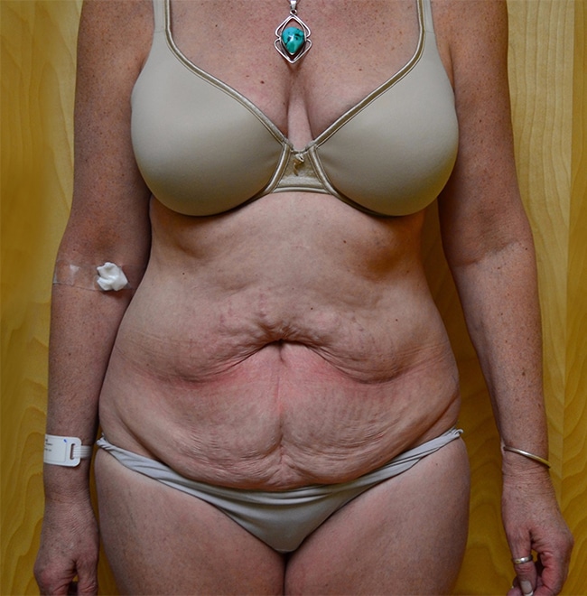 Before Image: Tummy Tuck - front