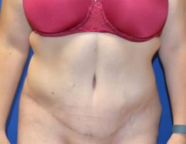 After Image: Tummy Tuck - front