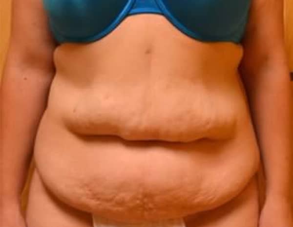 Before Image: Tummy Tuck - front