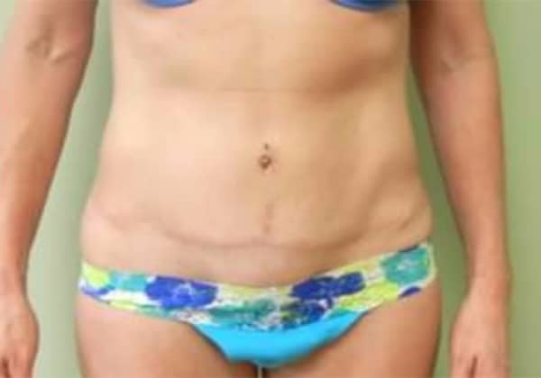 After Image: Tummy Tuck - front