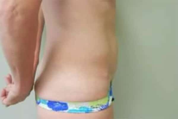 After Image: Tummy Tuck - right-side