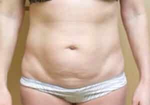 Before Image: Tummy Tuck